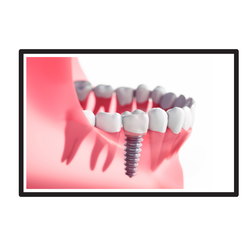 Dental Implants Made Easy